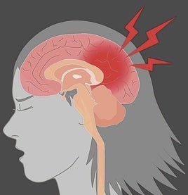 Men and women are different, even when it comes to strokes